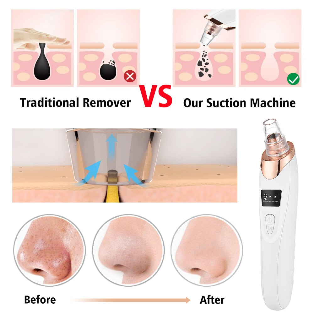 VIRTUAL INSTITUT™ -Aspirateur de points noirs, aspirateur à acné, nettoyeur de pores électrique pour le visage, soin exfoliant, instrument de beauté